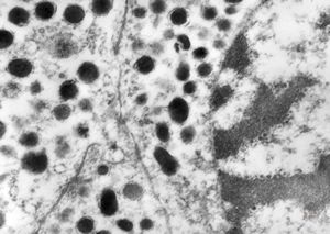 F, 71y. | carcinoid … metastasis to lymphonode